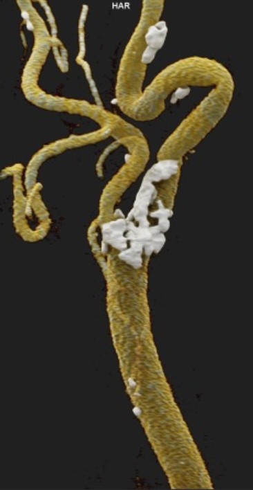 Vascular Scan with Plaque DICOM